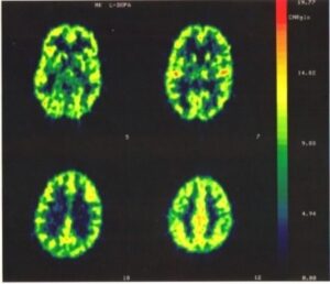 4 PET scan images of the author's brain